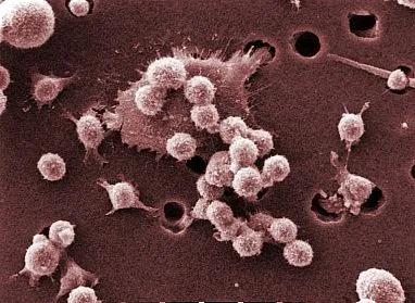 巨噬细胞（小而圆的细胞）正在攻击癌细胞。图片来源：Dr。 Raowf Guirguis， NCI。