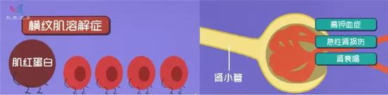 横纹肌溶解可致肾衰竭 (图片来源:作者自制)