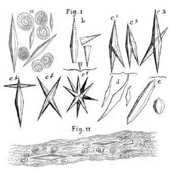 ▲Charcot医生最早描绘的CLC（图片来源：Science）