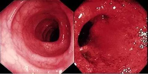 　正常肠道与炎症肠道