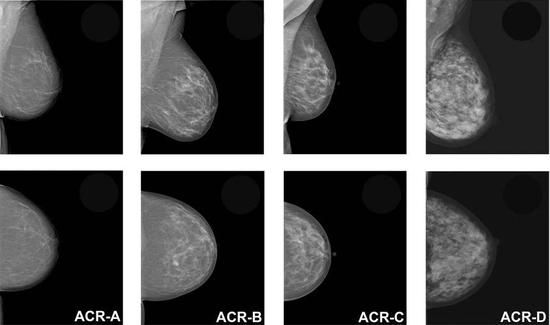 临床研究表明3D钼靶能比常规筛查多发现34%的乳腺癌