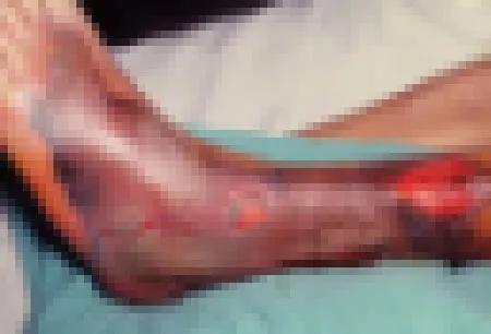 创伤弧菌感染后的腿