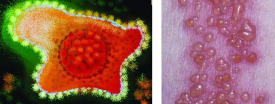 透射电子显微镜下的VZV及被感染者皮肤表面水痘（图片来源：pubmed）