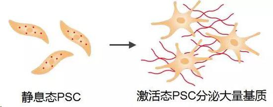 不能直接清除胰腺癌细胞 但是科学家可让改邪归正胰腺癌胰腺细胞