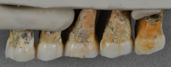 属于吕宋人的一些牙齿 图源：《卫报》