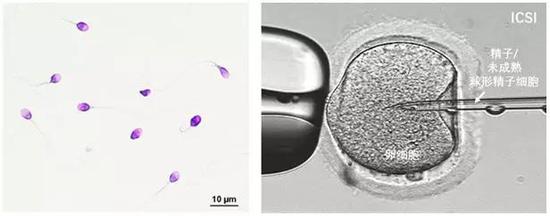 图2左：显微镜下的人精子；图2右：卵胞浆内单精子显微注射（intracytoplasmic sperm injection， ICSI），第二代体外受精-试管婴儿技术（图片来源于网络）