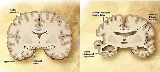 治疗阿尔茨海默病等神经退行性疾病，关键可能是“组合疗法”和“生物标志物”（图片来源：[Public domain]）