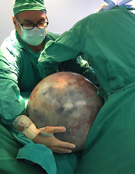 惊！哥斯达黎加女子体内取出34公斤重巨型肿瘤