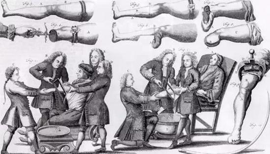 文艺复兴时期法国外科医生安布鲁瓦兹·帕雷（Ambroise Paré）所著的外科手术书籍中的插图，1564年。图源：Club de Réflexion Noctua et Bubo