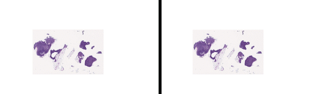 左侧：在逐渐增大的放大倍数下，含有小转移性乳腺肿瘤淋巴结的载玻片的样本视图。右侧：相同视图在使用算法辅助后（LYmph Node Assistant，LYNA）用蓝青色标注出肿瘤的位置。
