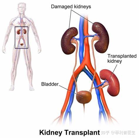 正常的肾移植方法