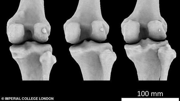 图中显示3个不同膝骨样本存在不同大小的豆骨。科学家发现1918年全球11.2%居民体内存在豆骨，但截至2018年，全球39%居民体内存在豆骨。