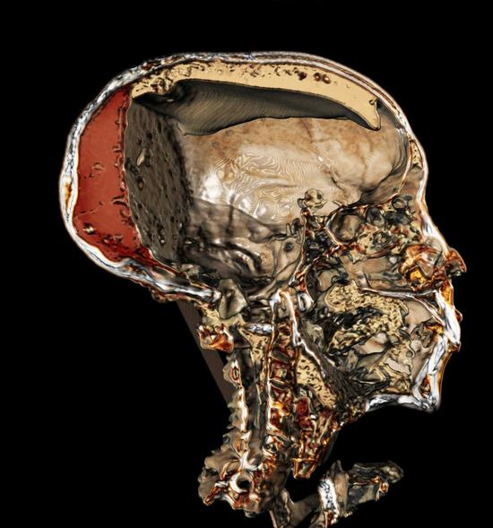 CT扫描揭示了图坦卡蒙王头部的内部精细结构，可以看到其头颅内部被灌入的植物树脂类充填物质