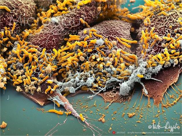 幽门螺杆菌是诱发胃癌的重要原因