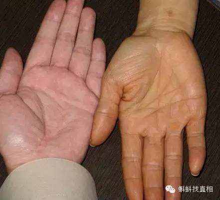 生吃胡萝卜的危害 正常手掌(左)与胡萝卜素血症手掌(右)对比