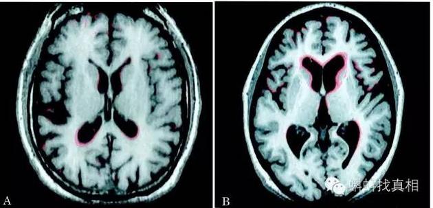 脑萎缩前后对比影像
