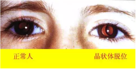 马方综合征:号称“天才病”的马凡氏综合征,究竟是什么?