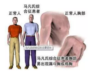 马方综合征:号称“天才病”的马凡氏综合征,究竟是什么?