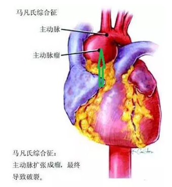 马方综合征:号称“天才病”的马凡氏综合征,究竟是什么?