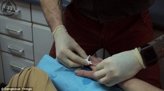 RFID芯片植入，针头会刺穿皮肤有轻微刺痛感