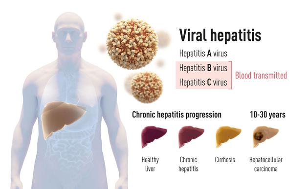 肝炎主要有两种形式。其一是由甲型肝炎病毒引起的急性疾病，该病毒通过被污染的水和食物传播。另一种是有乙型肝炎病毒或丙型肝炎病毒（今年的诺贝尔奖）引起的。这种血源性肝炎通常是一种慢性疾病，可能会发展为肝硬化和肝细胞癌。
