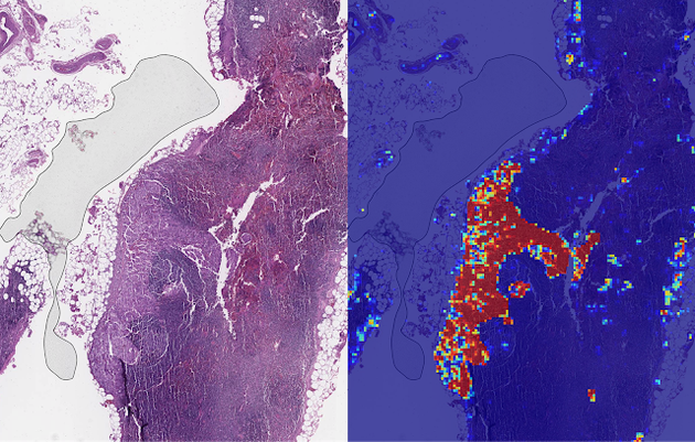 左侧：包含淋巴结的载玻片有多个组学伪影：左边较暗区域是气泡，白色条纹是切割组学伪影，一些区域的红色显示出血（含有血液），组织已经坏死（衰竭），治疗质量较差。右侧：LYNA 识别出肿瘤区域在中央（呈红色），并正确地对非肿瘤区域进行分类（呈蓝色） 。