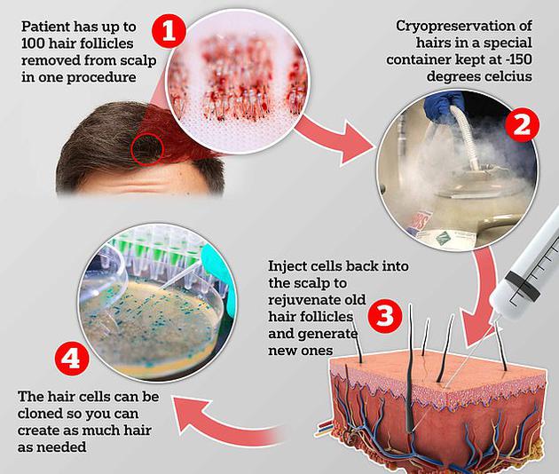 秃顶患者福音？英国公司推毛囊克隆技术应对脱发秃顶毛囊秃顶毛发