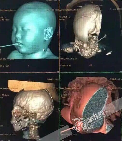 希希拍摄的CT。