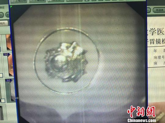 图为胃镜下看到的异物。西安交大一附院供图