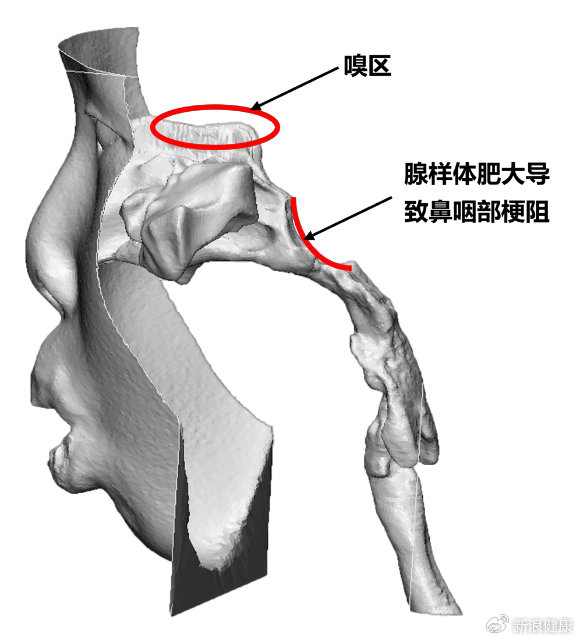 小儿慢性鼻窦炎合并腺样体肥大：通过计算模拟改进治疗策略