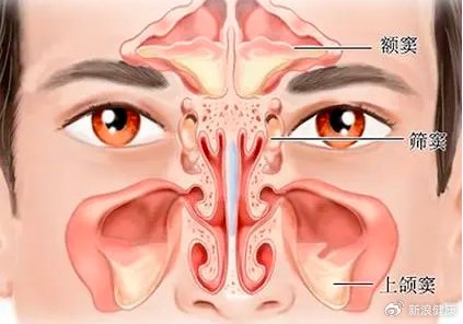 儿童感冒后咳嗽总不好，可能是鼻窦炎惹的祸。