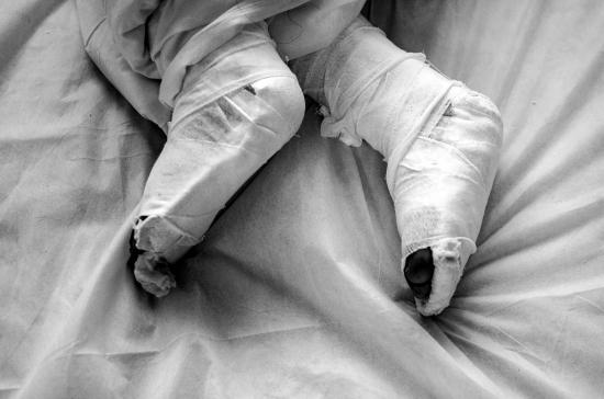 10月7日，长沙市中心医院，受伤女子的双脚已缠上纱布。 图/实习生陈明谋记者陈正