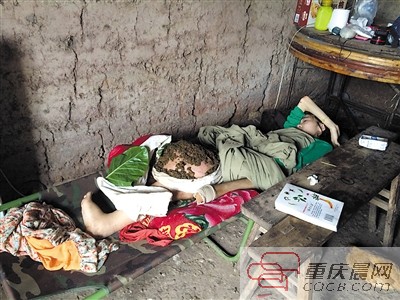 女孩患骨肉瘤左腿被截肢 右腿肿瘤有篮球大小