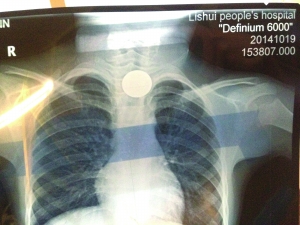 南京六龄童玩耍时误吞一元硬币