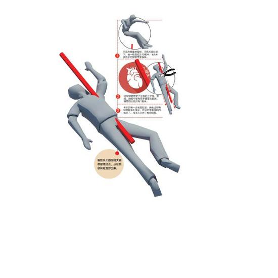 眉山工人高空坠落钢管穿身:与心脏擦肩而过_新浪四川_新浪网