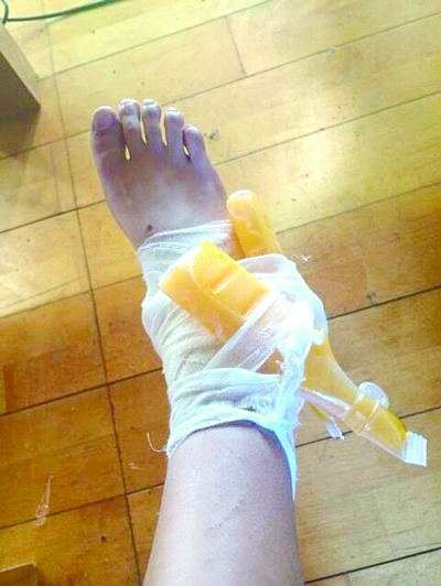 湖南一女大学生扭伤右脚 买两支冰棍冰敷(图)
