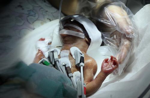 重庆660克早产手掌宝宝存活 怀孕仅23周