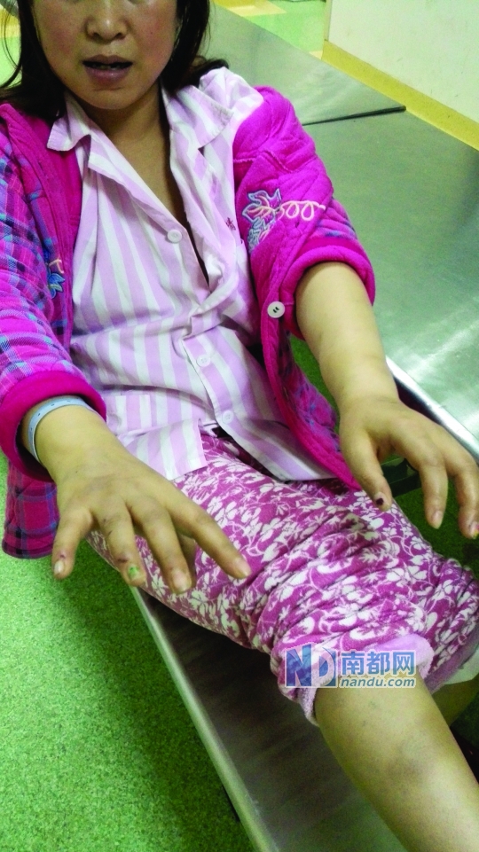 在精神病院住院期间，田菊红展示双手的伤痕，下巴上也可见明显伤痕。 家属供图