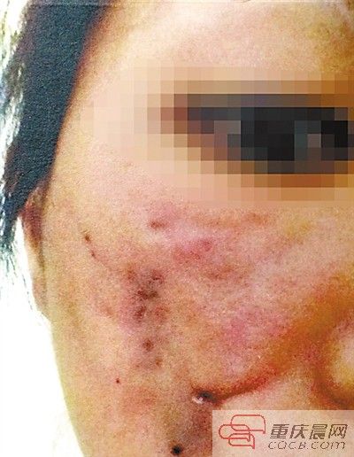 钟女士整形失败后的右脸