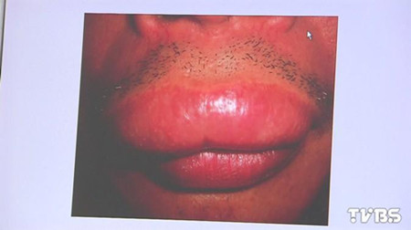 男子狂吃3天海鲜变香肠嘴 上唇比下唇大出1倍