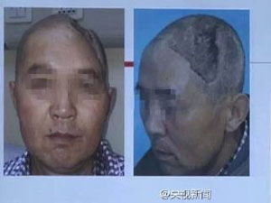 “半头人”植入3D打印技术