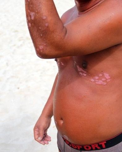 一名在大东海进行日光浴的皮肤病患者向记者展示自己患病部位。(三亚新闻网记者 邓松 摄)