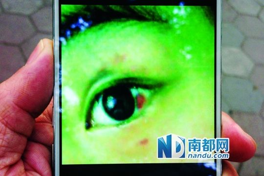 黄琪(化名)被打后拍下的照片，照片中显示其眼眶淤肿以及眼球出现血块。南都记者 黎湛均 摄