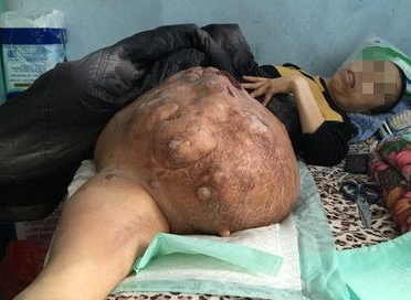 张世范的腿上长了一个大瘤子。