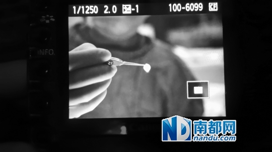 医生取出姚贝娜的眼角膜,准备移植给戴先生。医生姚晓明拍摄