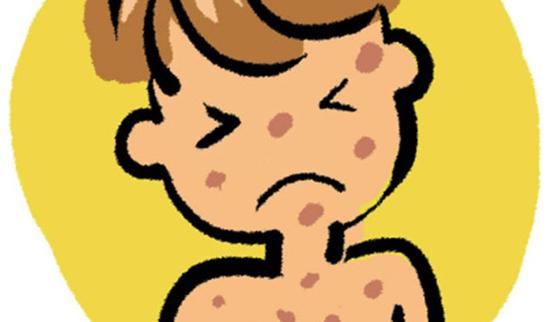 麻疹是儿童最常见的急性呼吸道传染病之一