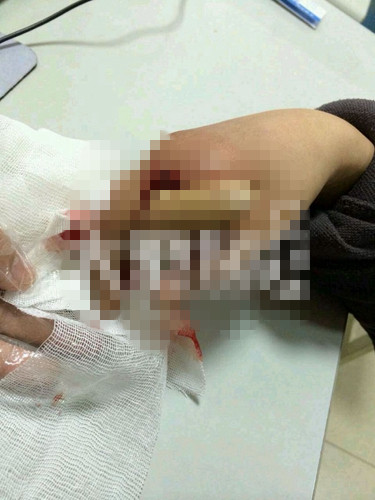 江阴10岁男童被老式洗衣机“咬断”手指