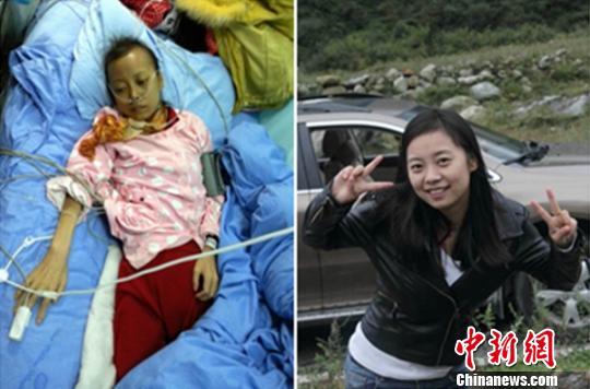 <em>乐山美女</em>患怪病暴瘦至40斤 男友护理一个月后