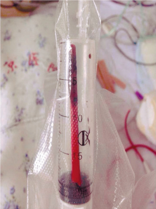 取出一截长达6厘米的红色塑料筷子。