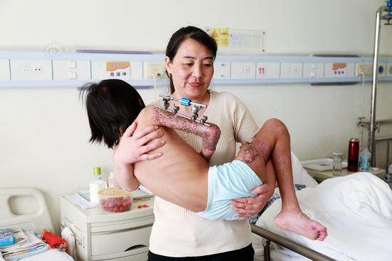 郴州11岁少女李皖湘放学路上被迎面开来的拉土车压过右腿和右侧手臂。(图片来源：千龙网)
